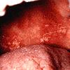 thumbnail image of Candidiasis: pseudomembranous