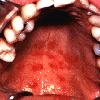 thumbnail image of Candidiasis: erythematous