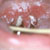 thumbnail image of Candidiasis: oral