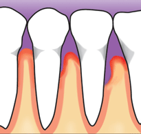 Plaque left on teeth hardens into tartar. As plaque and tartar build up, the gums pull away from the teeth and pockets form between the teeth and gums. Bone supporting the teeth may get infected and start to weaken.