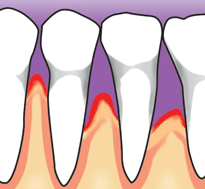 The gums recede further, destroying more bone and the ligament around the tooth. Teeth may become loose and need to be removed.