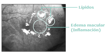 La retina antes del tratamiento focal con láser.