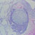 thumbnail image of Lymphocytic interstitial pneumonitis/pulmonary lymphocytic hyperplasia: lung biopsy