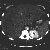 thumbnail image of Bartonella henselae/Bacillary angiomatosis: hepatosplenomegaly in peliosis hepatis