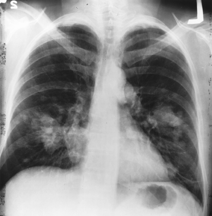 Conventional Lung X-Ray