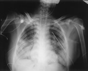 Photo of chest x-ray