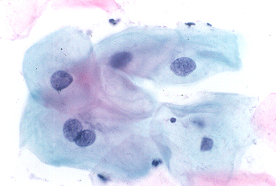 ASC-US: Squamous cells with some nuclear enlargement but still abundant cytoplasm.