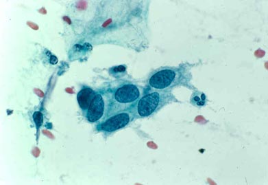 HIGH GRADE: Very enlarged blue nuclei with less abundant cytoplasm, resulting in a high nuclear to cytoplasmic ratio.