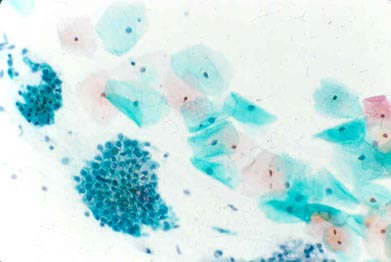 NORMAL: Squamous cells with small blue nuclei and abundant pink/green cytoplasm. A group of endocervical glandular cells can be seen in the lower left corner with a 