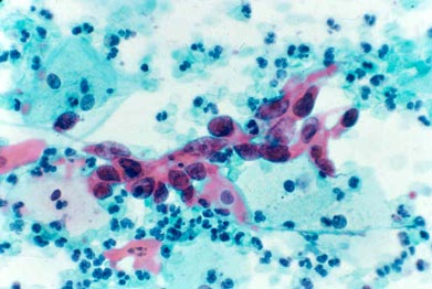 SQUAMOUS CANCER: Very enlarged nuclei with irregular distribution of nuclear material and nucleoli (red clumps in nuclei); dense spindled pink/orange cytoplasm.