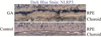 GA RPEs have more NLRP3 inflammasome proteins.