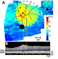 RPGR gene therapy preserves retinal thickness.