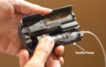 Image of Insulin Pump