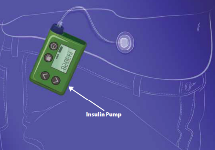 Image of Insulin Pump