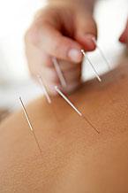 Practitioner applies acupuncture needles to a patient's shoulder.