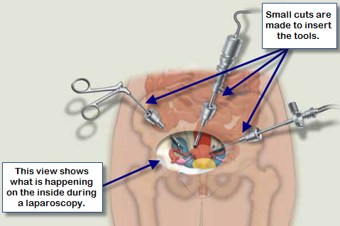laparoscopy graphic