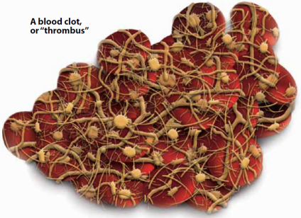 Image of a blood clot, or "thrombus"