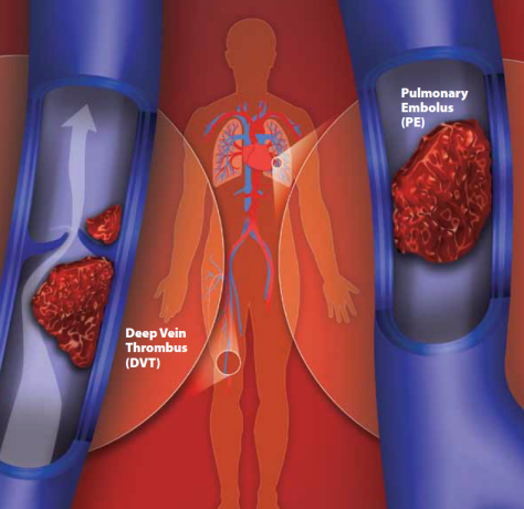 Image of deep vein thrombus (DVT) and pulmonary embolus (PE)