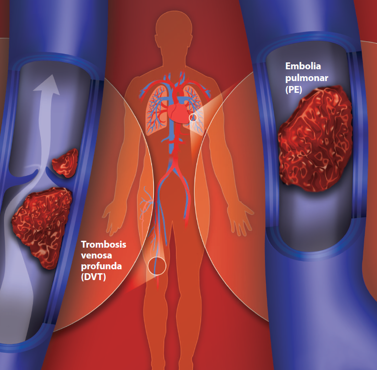 Trombosis venosa profunda (DVT) y Embolia pulmonar (PE)
