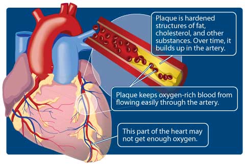 Image of human heart with an inset image of a cut away of an artery. The cut away displays how a build-up of plaque in the artery restricts the flow of oxygen-rich blood to other parts of heart.