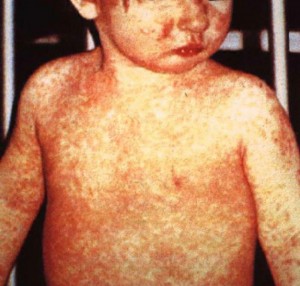 Child with measles rash across abdomen