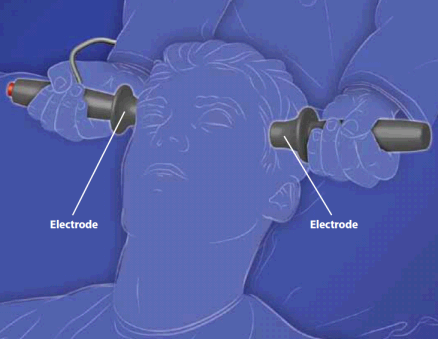 Image of electroconvulsive therapy.