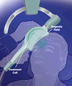 Image of Repetitive Transcranial Magnetic Stimulation