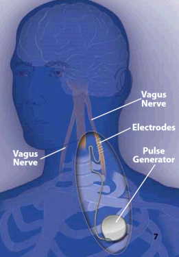 Image illustrating vagus nerve stimulation.