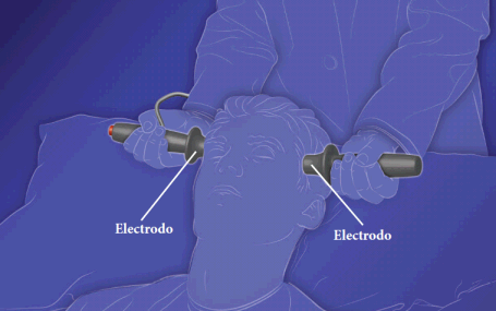 Terapia electroconvulsiva