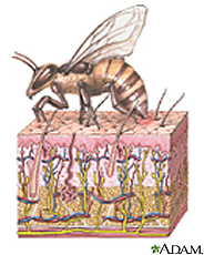 Ilustración de una abeja dejando su aguijón en la piel de su víctima