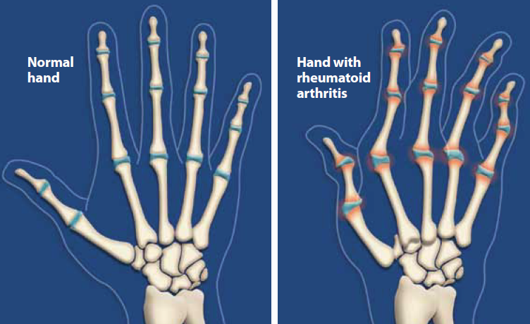Image showing a normal hand and a hand with rheumatoid arthritis