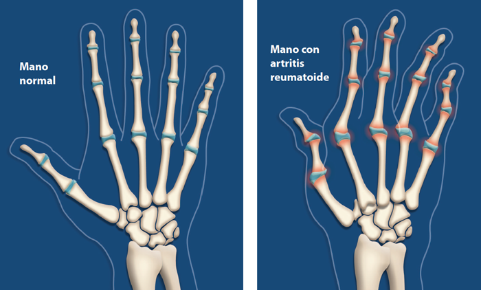 Imagen con un mano normal and un mano con artritis reumatoide
