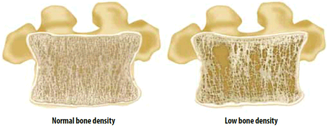 image of normal bone density and low bone density.