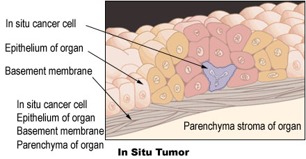 Illustration of an in situ tumor
