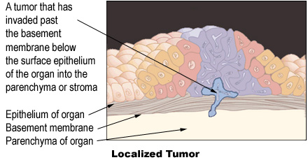 Illustration of a localized tumor