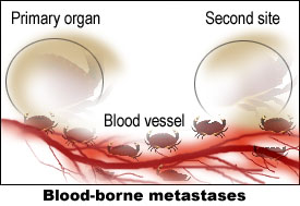 Blood-bourne metastases