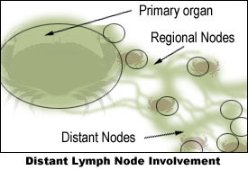 Distant lymph node involvement