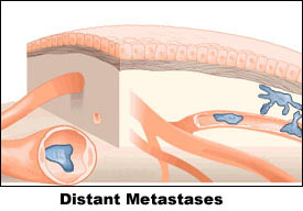 Distant Metastases