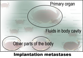 Implantation metastases