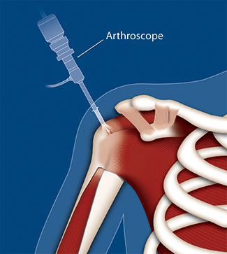 arthroscopic surgery