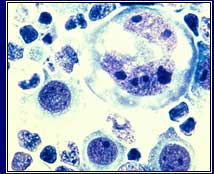 Lymphoma cells