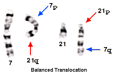 balanced translocation