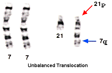 unbalanced translocation