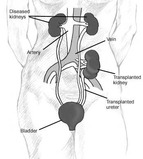 Drawing of diseased kidneys, artery, vein, transplanted kidney, transplanted ureter and bladder - Click to enlarge in new window.
