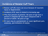 Incidence of Rotator Cuff Tears
Rotator cuff (RC) tears can occur because of traumatic injury or degeneration. Incidence of RC tears is related to increasing age. Fifty-four percent of patients >60 years of age have a partial or complete RC tear when compared with 4 percent of adults <40 years of age. RC tears may be asymptomatic or cause significant pain, weakness, and limitation of motion.