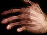 X-ray image -- Inflammation leads to pain in arthritis.