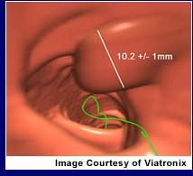 Virtual Colonoscopy