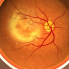 Macular Degeneration animation