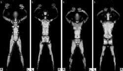 Ejemplos de escáneres corporales