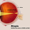 Ilustración a color de la miopía destacando la córnea, la pupila y el cristalino, y como la imagen se enfoca en frene de la retina. 